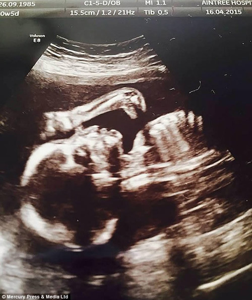 9. Ảnh siêu âm thai nhi giống như khủng long Sản phụ Lenne Sullivan đã vô cùng ngạc nhiên khi nhìn thấy hình ảnh siêu âm thai nhi cô con gái đầu lòng Ruthie-Lou 20 tuần tuổi của cô trông như một chú khủng long con sau khi chị thực hiện siêu âm tại bệnh viện. Sản phụ 29 tuổi đến từ Liverpool nước Anh đã không hề để ý thấy sự khác lạ từ bức ảnh siêu âm sau khi trở về nhà. Chỉ khi cô cho bạn bè và người thân xem, hình ảnh đập vào mắt đầu tiên là chiếc đầu và cổ dài giống như loài khủng long Apatosaurus, một chi khủng long Sauropoda từng sống ở Bắc Mỹ thời kỳ Jura Muộn. 