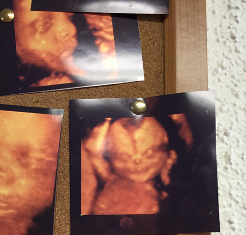 1. Khuôn mặt thai nhi không giống bình thường Cách đây không lâu, một người đàn ông đã bất ngờ khoe trên Reddit hình ảnh siêu âm thai đứa con của hai vợ chồng anh. Tuy nhiên điều đáng nói là hình ảnh em bé không giống như những thai nhi khác, bé có đôi mắt, mũi, miệng hoàn toàn khác người khiến chính người bố này cũng đặt một dấu hỏi nghi hoặc. 