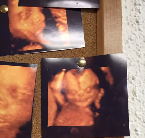 1. Khuôn mặt thai nhi không giống bình thường Cách đây không lâu, một người đàn ông đã bất ngờ khoe trên Reddit hình ảnh siêu âm thai đứa con của hai vợ chồng anh. Tuy nhiên điều đáng nói là hình ảnh em bé không giống như những thai nhi khác, bé có đôi mắt, mũi, miệng hoàn toàn khác người khiến chính người bố này cũng đặt một dấu hỏi nghi hoặc. 