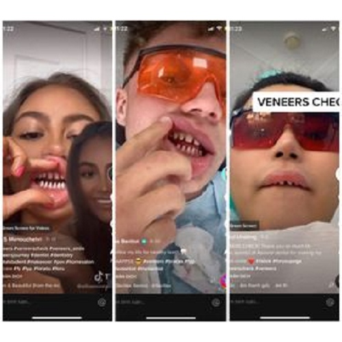 Trên TikTok xuất hiện một trào lưu khá rầm rộ với tên gọi “veneer vlog”. Trong các vlog này, họ chia sẻ những hình ảnh “bộ hàm cá mập” sau khi mài răng và cho biết đó là những bước chuẩn bị cho quy trình dán sứ veneer.