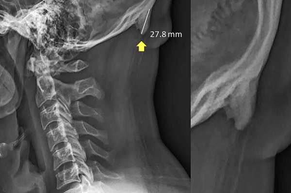 Smartphone mang đến nhiều hội chứng cho chúng ta mà hậu quả chưa thể lường trước. Hội chứng... mọc sừng là vì thói quen nghiêng đầu về phía trước khi sử dụng smartphone và các thiết bị điện tử cầm tay khác. Hành động này khiến trọng lượng dồn từ đốt sống cổ về phía các cơ sau đầu, khiến hộp sọ phải mọc thêm đốt xương như chiếc sừng để giảm bớt áp lực.