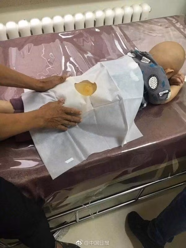 Trong ảnh là Bảo Bảo đang được kiểm tra và chữa trị. Nếu như những đứa trẻ khác đang ở độ tuổi ham ăn, ham ngủ, sống với những giấc mơ cổ tích của mình thì Bảo Bảo phải chiến đấu với bệnh tật. Những dòng hóa chất truyền vào cơ thể cậu bé khiến Bảo Bảo rụng hết tóc. (Nguồn Sina)