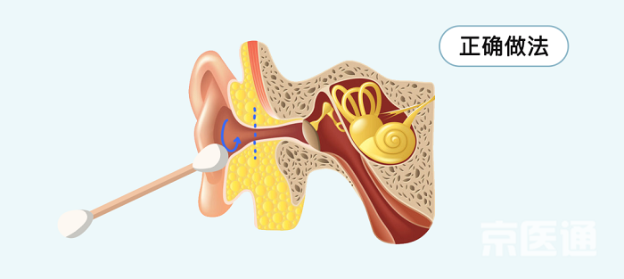Ngoáy tai. Không cần thiết phải ngoáy tai bởi ráy sẽ tự thải ra ngoài khi bị rung bởi các vận động hàng ngày. Hơn nữa, ngoáy tai không đúng cách dễ làm tổn thương màng nhĩ, đẩy ráy tai vào sâu ống tai. Nếu thấy ngứa, bạn nên dùng tay hoặc tăm bông để xoay tròn hai lần huyệt thính giác bên ngoài.
