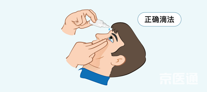 Nhỏ mắt. Nhỏ thuốc mắt trực tiếp vào lòng đen có thể gây kích ứng giác mạc, dẫn đến phản ứng chớp mắt ngay sau đó. Một khi chớp mắt, thuốc nhỏ mắt dạng lỏng sẽ nhanh chóng chảy ra ngoài làm giảm hiệu quả điều trị. Để làm đúng, bạn hơi ngửa đầu ra sau, nhìn lên rồi nhẹ nhàng dùng tay sạch kéo mi mắt xuống, nhỏ 1 giọt thuốc vào túi kết mạc (rãnh giữa mi dưới và lòng trắng). Tiếp đó, kéo nhẹ mi trên và mi dưới rồi nhắm mắt nghỉ ngơi trong vài phút.