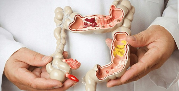 3 mùi – xì hơi. Xì hơi được xem là hiện tượng sinh lý bình thường. Khí được xì ra hình thành chủ yếu do vi khuẩn đường ruột phân hủy thức ăn, nuốt nhiều không khí hoặc do nhu động ruột...