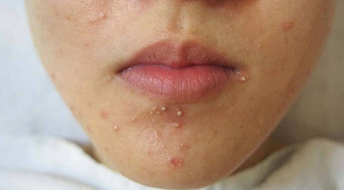 Mọc mụn. Trước kỳ kinh, cơ thể phụ nữ sẽ tăng lượng hormone estrogen và progesterone. Đây chính là lý do cằm của họ dễ bị nổi mụn trứng cá. Tuy nhiên, nếu mụn trứng cá nổi thường xuyên và không mất đi sau đó thì nó lại là dấu hiệu sức khỏe có vấn đề. Rất có thể, chị em đang bị rối loạn nội tiết tố mà không hề hay biết.