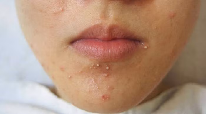 Mọc mụn. Trước kỳ kinh, cơ thể phụ nữ sẽ tăng lượng hormone estrogen và progesterone. Đây chính là lý do cằm của họ dễ bị nổi mụn trứng cá. Tuy nhiên, nếu mụn trứng cá nổi thường xuyên và không mất đi sau đó thì nó lại là dấu hiệu sức khỏe có vấn đề. Rất có thể, chị em đang bị rối loạn nội tiết tố mà không hề hay biết.