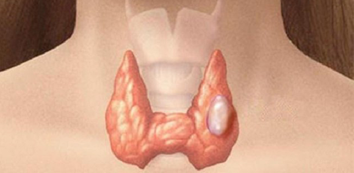 Bệnh nhân tuyến giáp là tổn thương dạng khối khu trú nằm ở tuyến giáp, làm thay đổi cấu trúc và chức năng của tuyến giáp. Nhân tuyến giáp đa phần là lành tính song nó vẫn có thể chuyển ác tính. Một khi di căn, bệnh gây ảnh hưởng nghiêm trọng đến sức khỏe, thậm chí uy hiếp tính mạng.