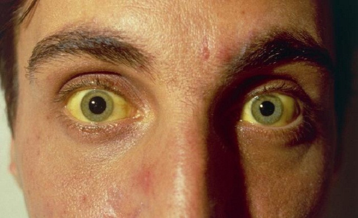 Ngoài trường hợp vàng da sinh lý do tăng bilirubin gián tiếp thường gặp ở trẻ sơ sinh, hầu hết các trường hợp vàng da bệnh lý ở người lớn đều có liên quan đến những bất thường về gan, mật và thường đã tiến triển nặng. Do đó nếu phát hiện cơ thể có dấu hiệu vàng da, ngứa da, sưng phù, đi phân bạc màu… người bệnh nên đến cơ sở y tế lớn để kiểm tra.