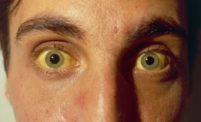 Ngoài trường hợp vàng da sinh lý do tăng bilirubin gián tiếp thường gặp ở trẻ sơ sinh, hầu hết các trường hợp vàng da bệnh lý ở người lớn đều có liên quan đến những bất thường về gan, mật và thường đã tiến triển nặng. Do đó nếu phát hiện cơ thể có dấu hiệu vàng da, ngứa da, sưng phù, đi phân bạc màu… người bệnh nên đến cơ sở y tế lớn để kiểm tra.