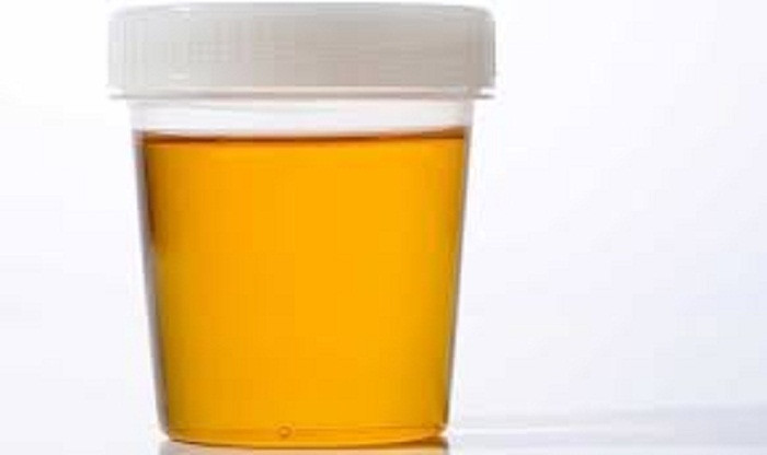 Một số trường hợp dùng thuốc, thực phẩm hằng ngày hoặc cơ thể thiếu nước cũng dẫn đến nước tiểu có màu vàng. Tốt nhất, bạn nên đi khám nếu tình trạng kéo dài dù cơ thể đã thay đổi thói quen sinh hoạt.