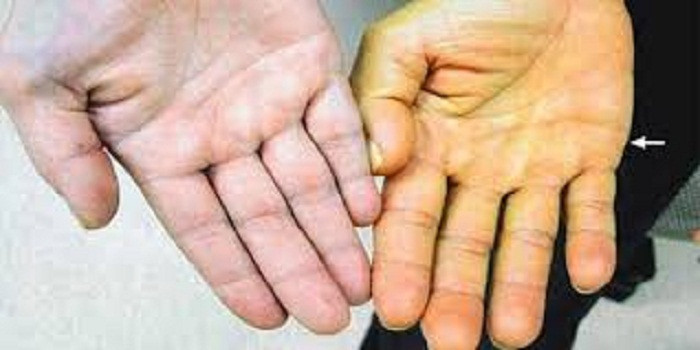 Vàng da. Triệu chứng vàng da thường xuất hiện ở các bệnh lý như viêm gan do virus, xơ gan. Đáng chú ý, khi vàng da kèm theo vàng kết mạc người bệnh nên nghĩ đến nguy cơ ung thư gan.