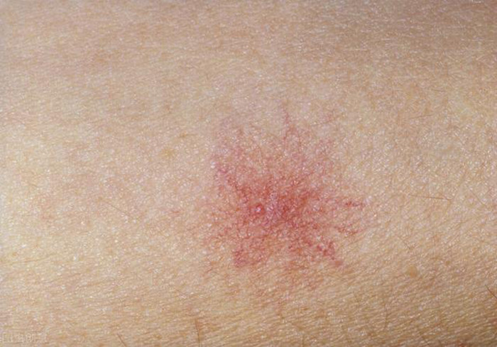 “Nốt ruồi máu”. Người mắc bệnh gan, đặc biệt là xơ gan thường xuất hiện “nốt ruồi máu” trên cơ thể. Tên gọi “nốt ruồi máu” bắt nguồn từ màu sắc của chúng. Thông thường, nó sẽ có tâm màu đỏ và có cạnh viền tỏa tròn ra các bên. Đặc biệt, nốt ruồi máu không nhô lên khỏi mặt da, các cạnh lan ra giống như hình mạng nhện.