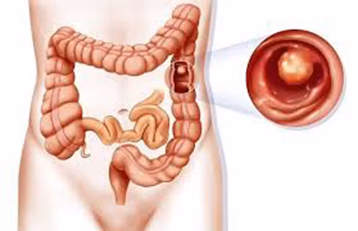 Polyp đại tràng. Polyp đại tràng là khối tế bào hình thành trên niêm mạc đại tràng. Hầu hết các polyp đại tràng là vô hại nhưng qua thời gian, một số polyp có thể phát triển thành ung thư. Ước tính, mất khoảng 5 – 10 năm để polyp trực tràng chuyển dạng ác tính.