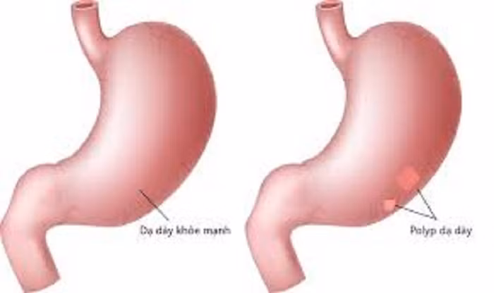 Polyp dạ dày. Giống như polyp đại tràng, polyp dạ dày có nguy cơ chuyển thành ác tính. Ở đó, polyp dạ dày là những khối u lồi có hình dạng khác nhau (dạng elip hoặc hình tròn), có cuống, đôi khi còn được gọi là khối u. Khối u này được hình thành do sự tăng sinh quá mức của niêm mạc dạ dày.