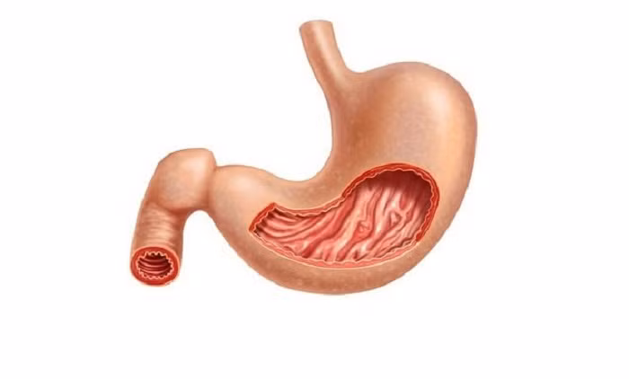 Viêm teo niêm mạc dạ dày. Viêm teo niêm mạc dạ dày là hiện tượng do các vi khuẩn H.pylori gây viêm loét dạ dày, phá hủy niêm mạc sau một thời gian dài gây nên.