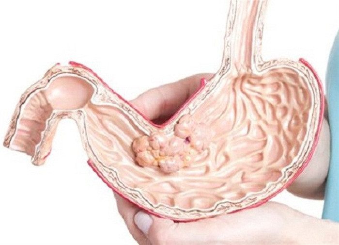 Polyp dạ dày thường không gây ra triệu chứng đặc hiệu. Tuy nhiên, polyp dạ dày to, loét có thể gây đau dạ dày, đau khi đấm nhẹ vào bụng, buồn nôn, tiêu ra máu, ăn khó tiêu...