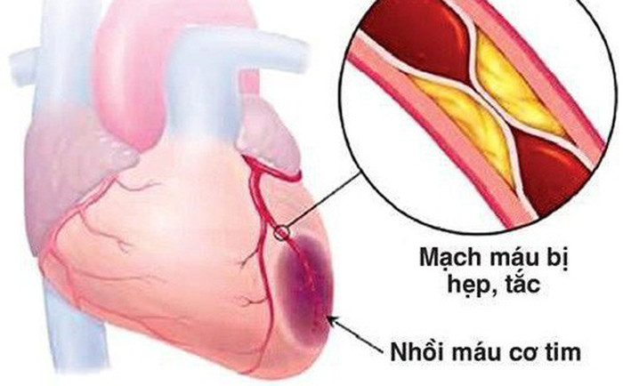 Hôm đó khi đang chơi mạt chược, cả nhóm thấy buồn ngủ nên liên tục uống nước ngọt, hút thuốc để tỉnh táo. Bản thân ông Vương cũng hút chừng gần 3 hộp. Lúc đứng dậy đi vệ sinh, ông cảm thấy đau ngực dữ dỗi rồi ngã vật xuống đất. Dù được các bạn đưa tới bệnh viện ngay sau đó nhưng bác sĩ cho biết bệnh nhân bị nhồi máu cơ tim không thể cứu vãn. Từ sự việc đau lòng trên, chuyên gia sức khỏe khuyên không nên bỏ qua những cơn đau dù ngắn ngủi sau để tránh sự việc đau lòng.