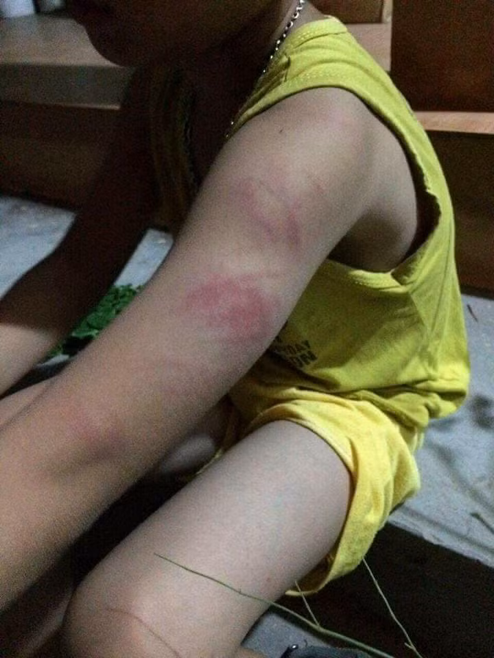 Tay cháu bé bị bầm tím.