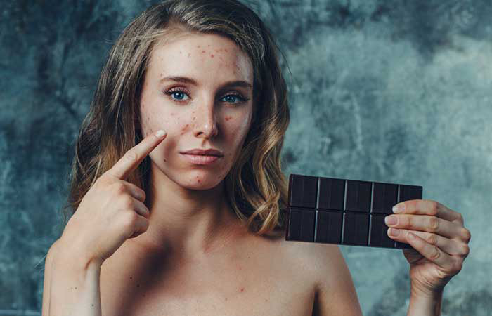 Sô-cô-la và mụn? Một nghiên cứu năm 2013 cho rằng, sô-cô-la có thể làm tình trạng mụn trở nên nghiêm trọng hơn. Một nghiên cứu khác năm 2014 lại chỉ ra rằng, mức độ tiêu thụ cacao có thể làm tăng các triệu chứng mụn. Tuy nhiên, bằng chứng chứng minh sự liên quan của sô-cô-la trong quá trình làm mụn nặng thêm lại rất hạn chế. Nhiều khả năng các thành phần khác trong sô-cô-la mới là nguyên nhân khiến mụn trầm trọng hơn. Nếu bạn phân vân có nên ăn sô-cô-la hay không, thì hãy chọn sô cô la đen và kiểm tra lượng đường cùng các thành phần hy-đrát-các-bon (carbohydrate) trước khi ăn.