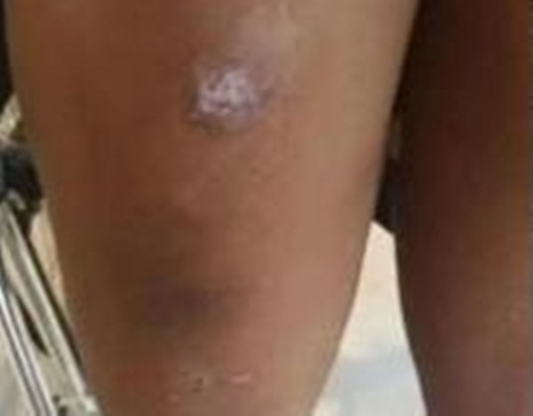 Hai cựu học viên của trường Kha Trinh cho biết Tiểu Lâm ban đầu hơi mập mạp và khó theo kịp các bài tập thể lực, vì vậy nữ sinh đã bị các huấn luyện viên trừng phạt nghiêm khắc. Ví dụ, dù Tiểu Lâm đã kiệt sức, cô bé vẫn bị kéo ra phơi nắng, bị buộc tóc vào cột và đánh vào đầu, thậm chí bị bắt cởi quần áo và bò trên mặt đất.