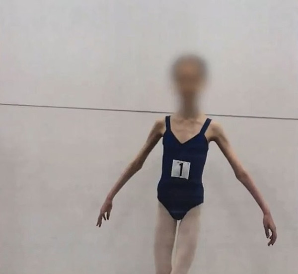 Tuy nhiên, không chỉ riêng cô giáo múa, các phụ huynh khác trong lớp học cũng nhận thấy A.H gầy bất thường. Họ đã cùng nhau báo cáo sự việc cho cơ quan chức năng.