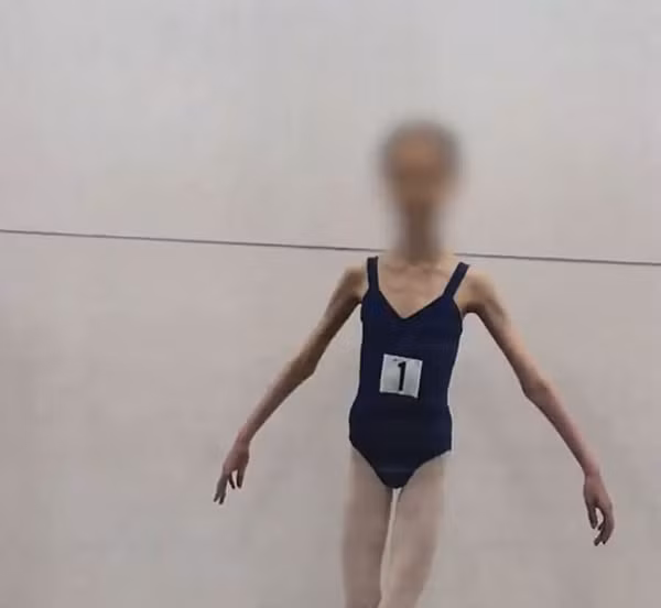 Tuy nhiên, không chỉ riêng cô giáo múa, các phụ huynh khác trong lớp học cũng nhận thấy A.H gầy bất thường. Họ đã cùng nhau báo cáo sự việc cho cơ quan chức năng.