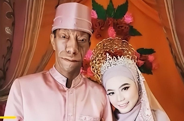 Sau khi gia đình Surya nổi tiếng, nhiều người đã tò mò về lý do tại sao họ lại có ngoại hình kỳ lạ như vậy. Một số người nghi ngờ rằng họ đã bị "nguyền rủa" hoặc tiếp xúc với điều gì đó "không sạch sẽ" dẫn đến sự biến đổi về gen.