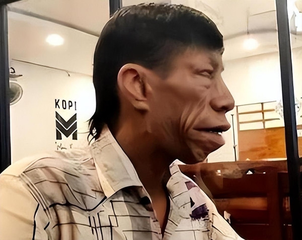 Tuy nhiên, nhiều người vẫn lo ngại rằng liệu con cái của họ có di truyền căn bệnh này hay không, và nếu có chúng sẽ phải đối mặt với những khó khăn mà cha mẹ chúng từng trải qua.