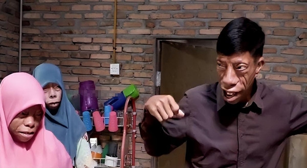 Tuy nhiên, các chuyên gia đã xác định rằng gia đình này mắc một căn bệnh di truyền hiếm gặp có tên là hội chứng Treacher-Collins, một rối loạn di truyền đặc trưng bởi các dị tật ở tai, mắt, xương gò má và cằm. Cha của Surya cũng mắc căn bệnh này và có khuôn mặt giống các con.