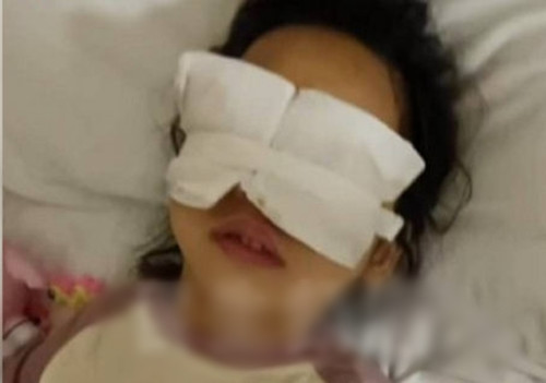 Sự việc khiến dư luận bức xúc vừa xảy ra tại Tân Trịnh, Hà Nam, Trung Quốc. Một bé gái 4 tuổi được đưa đến bệnh viện công lập địa phương để phẫu thuật cắt bỏ khối u nang nhỏ ở mắt phải. Thế nhưng, sau khi phẫu thuật, gia đình phát hiện ra rằng cả mắt trái của bé gái cũng đã được phẫu thuật. (Nguồn: Sina)