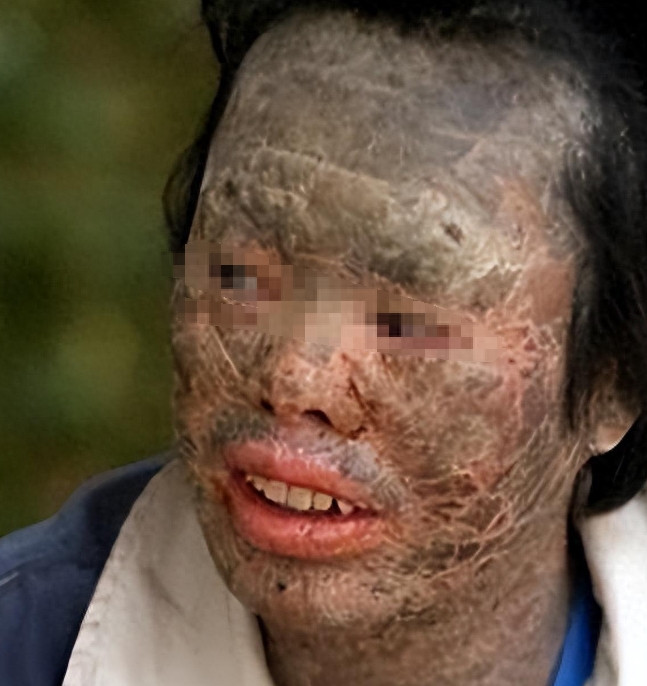 Chỉ trong thời gian ngắn, da của ông bắt đầu ngứa ngáy và xuất hiện vảy giống như vảy cá, cứ chạm vào là rơi rụng. Gia đình ông Hàn rất hoảng sợ, gọi bác sĩ địa phương đến khám nhưng không ai biết cách chữa trị. Bệnh tình của ông ngày càng trầm trọng hơn, da khô ráp và cứ thay liên tục như một lớp da rắn. Ông Hàn không thể chịu được lạnh, phải mặc nhiều lớp áo và đắp chăn dày, nhưng vẫn cảm thấy lạnh lẽo và đau đớn.