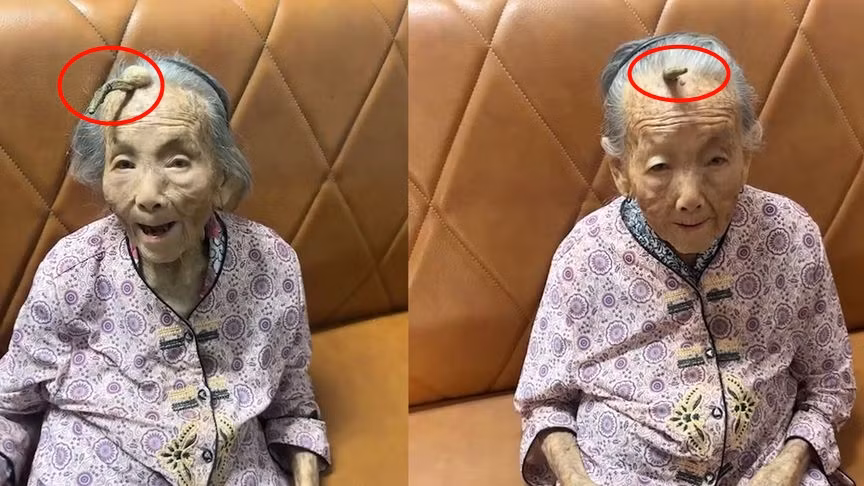 Một trường hợp "quái nhân" kỳ lạ đang thu hút sự chú ý của dư luận tại thành phố Phổ Ninh, thị Yết Dương, tỉnh Quảng Đông, Trung Quốc. Bà Trần, 107 tuổi, bất ngờ mọc sừng trên trán, khiến gia đình, hàng xóm và nhiều người địa phương không khỏi choáng váng, đặt câu hỏi về nguyên nhân. (Ảnh: Sohu, Sinchew, Ixigua)
