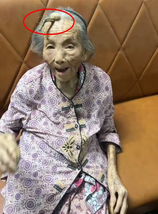 Tuy nhiên, theo các bác sĩ, chiếc sừng này không phải là một hiện tượng siêu nhiên mà là một căn bệnh về da.