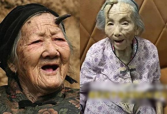 Bên trái ảnh là bà bà Trương, 101 tuổi ở Hà Nam, cũng mọc sừng tương tự. Bác sĩ Viên cho biết sừng da thường xuất hiện ở người trung niên và cao tuổi từ 40, 50 tuổi trở lên. Ngoài tuổi tác, việc thường xuyên tiếp xúc với ánh nắng mặt trời cũng là một yếu tố nguy cơ.