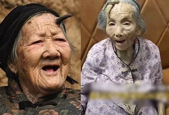 Bên trái ảnh là bà bà Trương, 101 tuổi ở Hà Nam, cũng mọc sừng tương tự. Bác sĩ Viên cho biết sừng da thường xuất hiện ở người trung niên và cao tuổi từ 40, 50 tuổi trở lên. Ngoài tuổi tác, việc thường xuyên tiếp xúc với ánh nắng mặt trời cũng là một yếu tố nguy cơ.