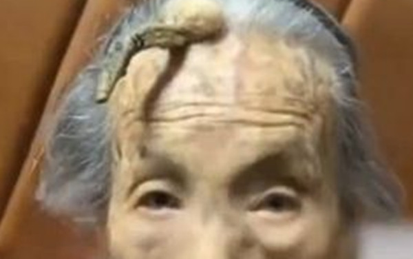 Tuy chiếc sừng trông rất kinh dị, khiến nhiều người không khỏi rùng mình và liên tưởng đến nhiều câu chuyện "truyền thuyết đô thị" nhưng bà cụ vẫn giữ tinh thần lạc quan, sức khỏe tốt và ăn uống ngon miệng.