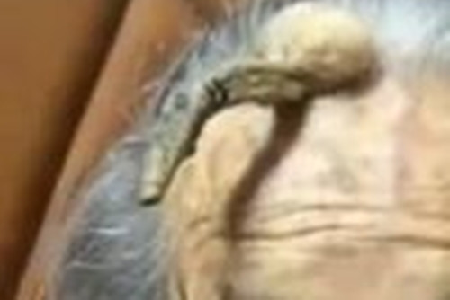 Bác sĩ Viên Dũng Mưu, Phó trưởng khoa Bệnh viện Phòng chống Bệnh da liễu Vũ Hán, giải thích rằng chiếc sừng trên đầu bà Trần thực chất là "sừng da", thường phát triển trên nền tảng của các bệnh da liễu khác, bao gồm cả u nhú do virus u nhú ở người (HPV) gây ra, bệnh sừng hóa bã nhờn (tử tế), ung thư biểu mô tế bào vảy (ác tính).