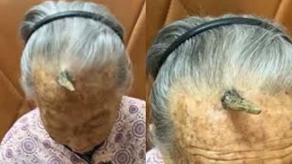 Trước bà Trần thì bà Lý, 90 tuổi, ở Vũ Hán, cũng từng trải qua tình trạng tương tự. Vào năm 2022, bà Lý mọc một cục u nhỏ ở khóe mắt phải, dần dần phát triển thành một chiếc "sừng" dài 5cm, khiến mí mắt phải bị sưng húp, ảnh hưởng nghiêm trọng đến thị lực.
