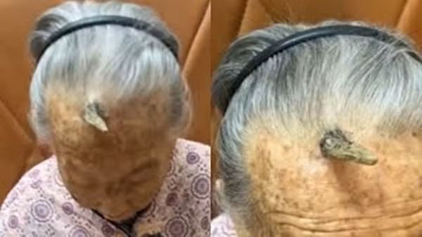 Trước bà Trần thì bà Lý, 90 tuổi, ở Vũ Hán, cũng từng trải qua tình trạng tương tự. Vào năm 2022, bà Lý mọc một cục u nhỏ ở khóe mắt phải, dần dần phát triển thành một chiếc "sừng" dài 5cm, khiến mí mắt phải bị sưng húp, ảnh hưởng nghiêm trọng đến thị lực.