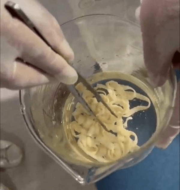 Qua quá trình hỏi bệnh kỹ lưỡng, các bác sĩ đã phát hiện ra rằng người phụ nữ này đã ăn thịt bò sống tại một địa điểm du lịch hồi đầu năm. Đây được cho là nguyên nhân chính dẫn đến việc nhiễm ký sinh trùng.