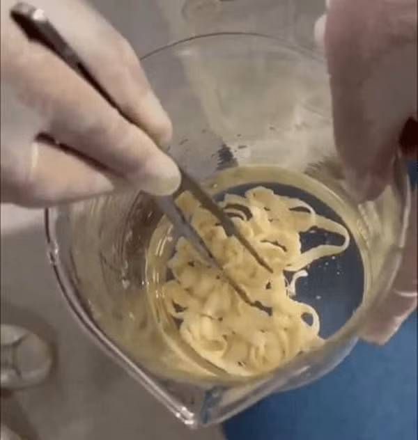 Qua quá trình hỏi bệnh kỹ lưỡng, các bác sĩ đã phát hiện ra rằng người phụ nữ này đã ăn thịt bò sống tại một địa điểm du lịch hồi đầu năm. Đây được cho là nguyên nhân chính dẫn đến việc nhiễm ký sinh trùng.