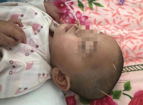 An keo ong tre dua, be gai 2 tuoi sui bot mep suyt chet