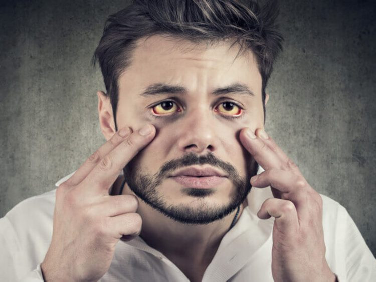 Đó là do chức năng tiết mật của gan bị suy yếu, ảnh hưởng đến quá trình hấp thụ chất béo của cơ thể khiến cơ thể chán ăn, ăn uống không ngon miệng.