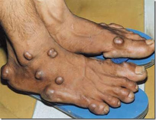 Tốt cho bệnh nhân gút. Gút là một trong những dạng viêm khớp gây đau đớn nhất. Để giảm đau, các chuyên gia khuyên người mắc gút nên ăn chừng 9 – 12 quả/lần. Mỗi ngày ăn ba lần sẽ có tác dụng đáng kể.