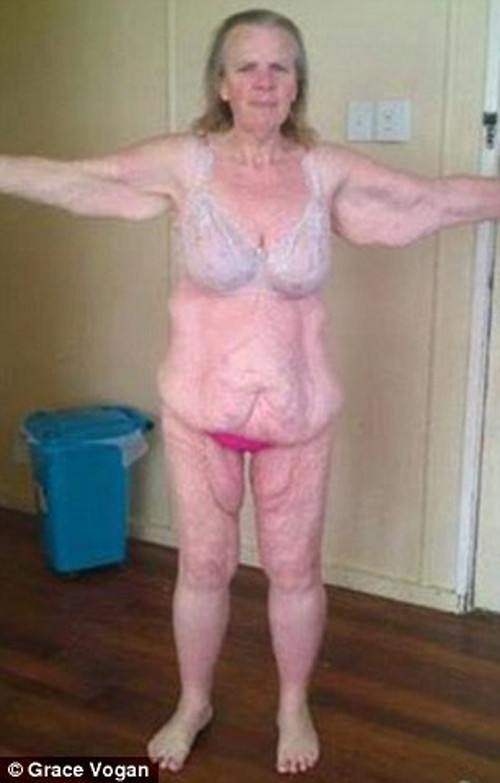 Thật không may, nỗ lực giảm cân triệt để khiến lớp da phần bụng, chân và cánh tay Grace trở nên nhăn nhúm, chảy xệ khủng khiếp.