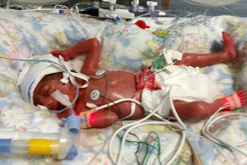 Khi mới chào đời, cô bé nặng 720g cùng kích thước chỉ bằng chai nước 7UP nhỏ. Khi đặt giữa những con búp bê, Matilda trông lọt thỏm. Ngoài cân nặng khiêm tốn, Matilda còn là đứa trẻ thiếu tháng, sinh ra khi mới được 26 tuần. Vì vậy khả năng nghe của bé không phát triển toàn diện, rất dễ bị viêm nhiễm.