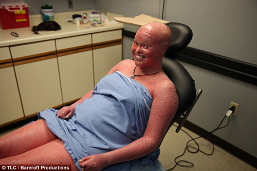 Đặc biệt, khi trời nắng nóng, làn da Stephanie bị tổn thương khủng khiếp. Chúng bắt đầu tấy đỏ, sưng lên và mưng mủ. Mọi hoạt động cần phải hạn chế tối đa bởi cử động mạnh có thể khiến cô đau đớn vô cùng.