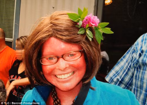 Giờ đây khi đã 23 tuổi, Stephanie trở thành người mắc hội chứng Harlequin sống lâu nhất nước Mỹ. Mắc chứng này, làn da của Stephanie phát triển nhanh hơn gấp 7 lần so với bình thường. Mỗi lần “lột”, da của cô bong ra, tạo thành vết nứt kéo dài vô cùng đau đớn. Tóc, lông mày, mí mắt của Stephanie cũng không thể mọc được.