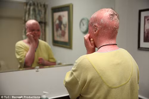 Ngoài việc thường xuyên bị chế giễu bởi làn da đỏ au như bị nướng, cô gái 23 tuổi này cũng rất dễ bị nhiễm trùng bởi làn da thường xuyên nứt rạn của cô khó có thể bảo vệ chủ nhân khỏi sự tấn công của vi khuẩn. Hàng ngày, Stephanie phải dùng kem để làm mềm da, chống khuẩn.